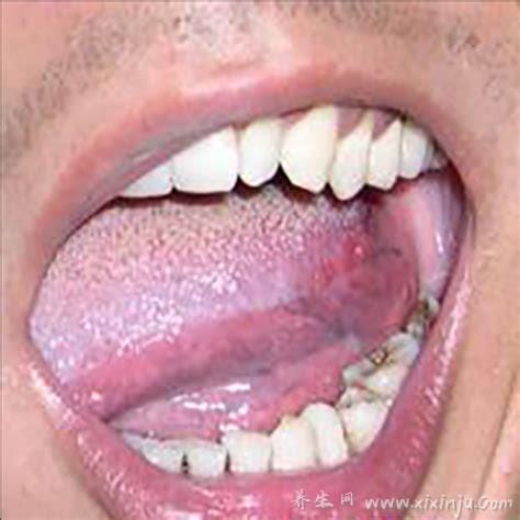 舌癌的早期症状图片,初期会有溃疡白斑容易被忽略(胆小慎入)