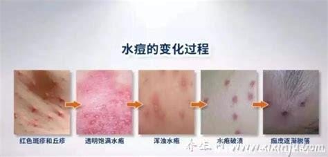 水痘的7天演变过程图片,从红色皮疹到水泡到结痂脱落痊愈