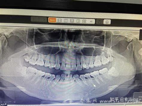 拔智齿要花多少钱一颗,上颌的智齿会相对便宜( 大致几百到千元 )