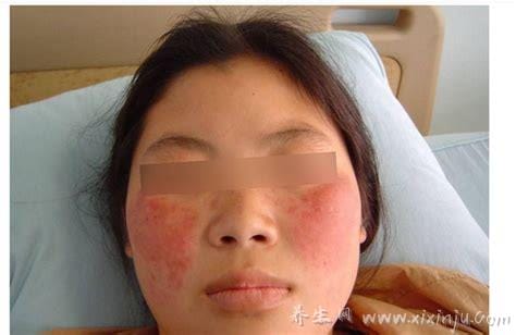 红斑狼疮早期症状图片,初期皮肤有蝴蝶型红斑伴随严重脱发