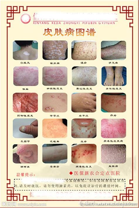 18种常见的皮肤病图片对照表,湿疹/荨麻疹/扁平疣/毛囊炎合集