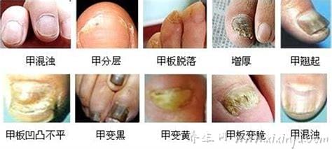 最轻微的初早期灰指甲图片,出现这这两种症状需要及时治疗