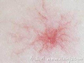蜘蛛痣图片及症状,由于肝脏受损出现的血管痣看起来很吓人