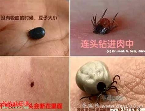 恙虫咬人伤口初期图片症状,咬过后有黑色焦痂不痛不痒但严重致命