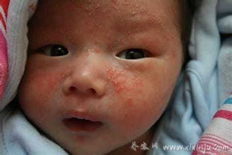 真实新生儿湿疹图片,小儿湿疹有三大类型注意区分