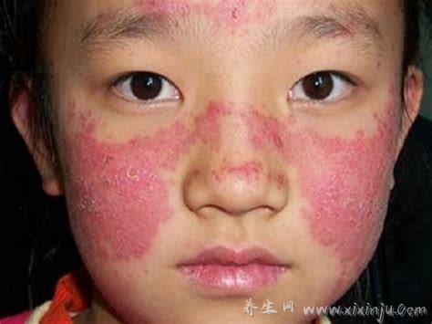 初期红斑狼疮早期症状图片,脸颊蝶状红斑不痒(15到40女性)