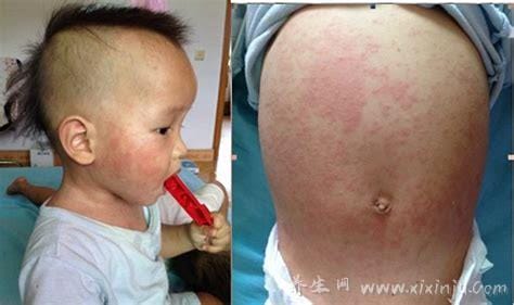 幼儿急疹图片初期症状图,高烧4天后全身长粉色斑点样皮疹(家长必看)
