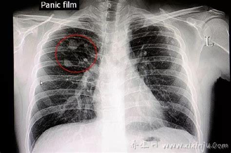 肺部有结节是怎么回事?要紧吗?不要惊慌大部分是良性的炎症