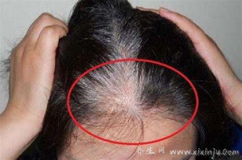 三个部位长白发最危险,两鬓/后脑勺/前额头有可能影响性生活