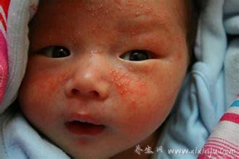 新生儿湿疹图片症状及护理方法,呈明显红肿有强烈瘙痒感
