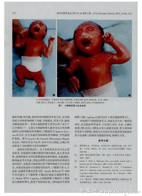 火棉胶婴儿长大后图片,少部分患者可以恢复正常皮肤