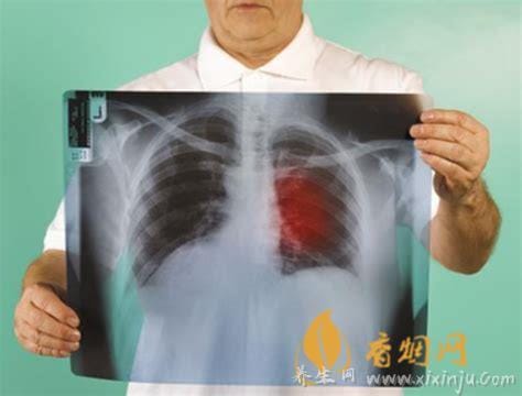 肺癌早期有三处痛,胸/嗓子/下肢关节痛(附肺癌背疼位置图)