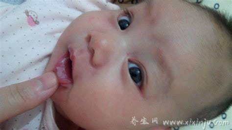 婴儿鹅口疮最早期图片,雪口病与奶苔不同需尽早治疗