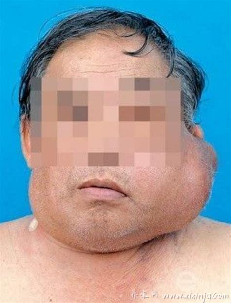 淋巴结肿瘤早期症状,典型症状无痛性淋巴结肿大图片(脖子和腋下图)