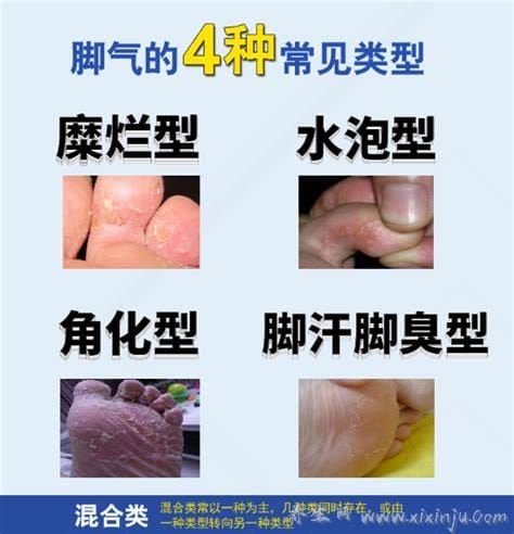 4种不同类型脚气的图片,脚部水疱或溃烂都可能是脚气引起的