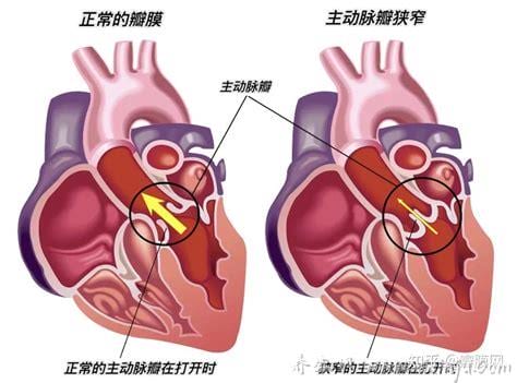 三尖瓣关闭不全轻度怎么处理