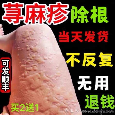  荨麻疹可以擦什么止痒