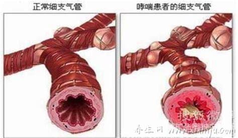 支气管扩张是怎么引起的