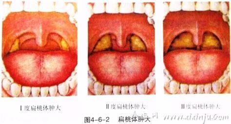 扁桃体炎患者能抽烟吗