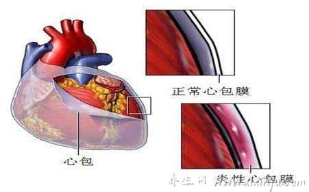  心包炎是什么疾病