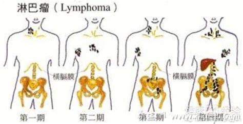  淋巴癌是什么引起的