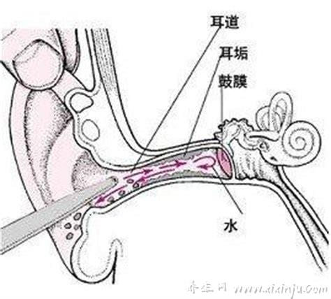 耳耵聍栓塞怎么取出