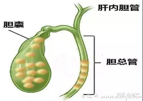 胆总管扩张是什么病严重吗