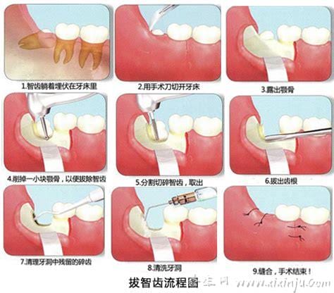  拔除智齿的危害有哪些