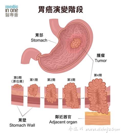 胃癌的早期症状女性