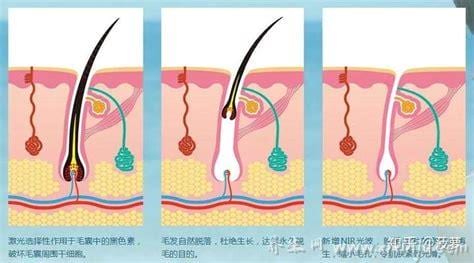  怎么样才可以永久脱毛