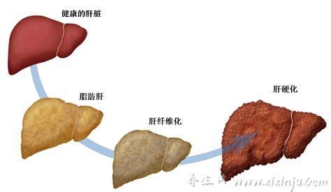 脂肪肝轻度是什么意思