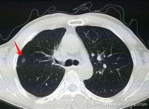  肺子上有结节是怎么回事