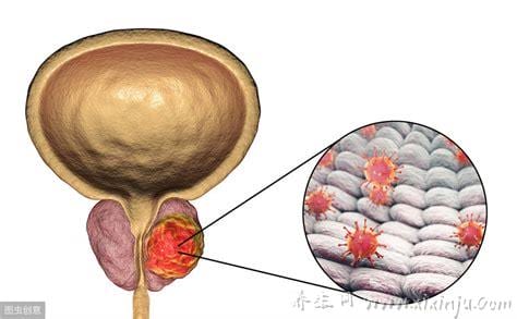 前列腺钙化怎么治疗