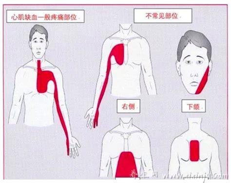 心绞痛典型发作部位