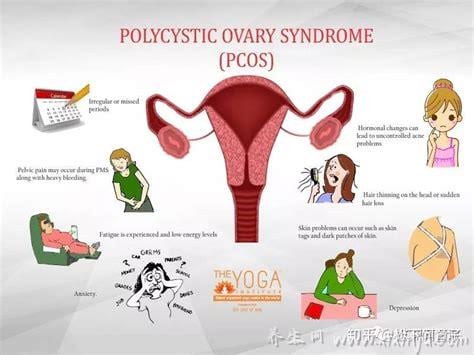  多囊卵巢综合症症状是什么