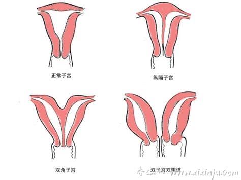 双阴道双子宫怎么回事