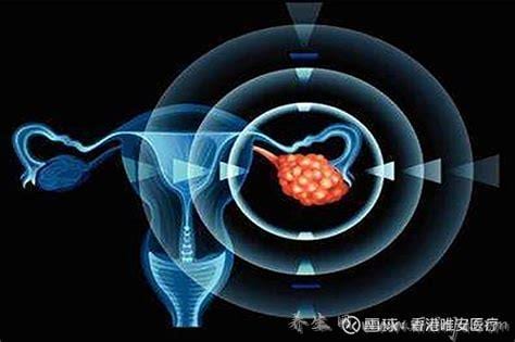 这些癌症信号要警惕 腹胀或是卵巢癌