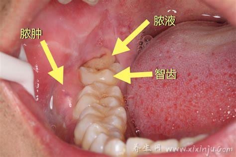  拔智齿化脓了怎么办