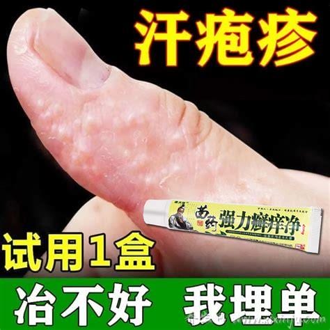  汗疱疹用什么药膏好