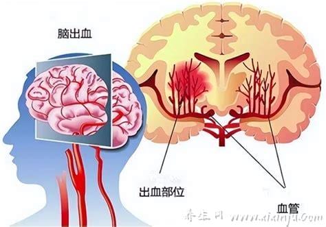  脑出血的常见病因