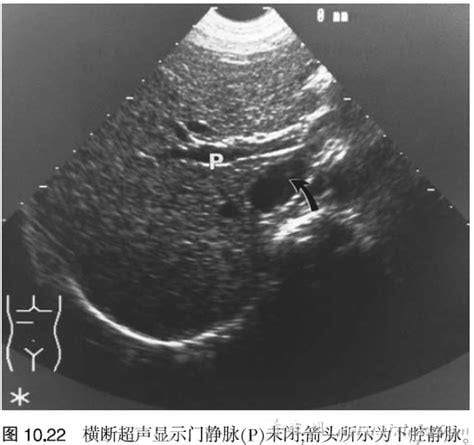 门静脉系统彩超检查的是什么