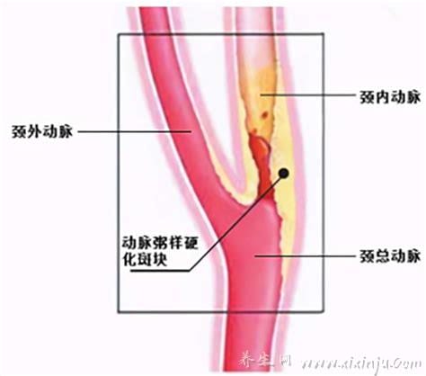  颈动脉狭窄是什么情况