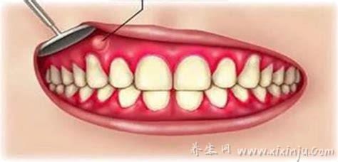  牙根脓包会自己消除吗