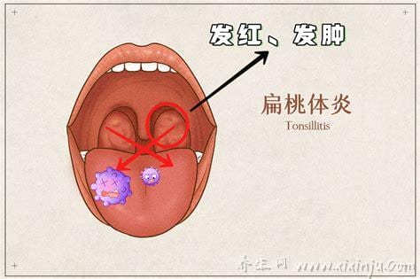 扁桃体发炎图片