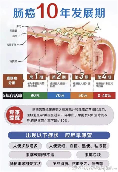  结肠癌早期症状