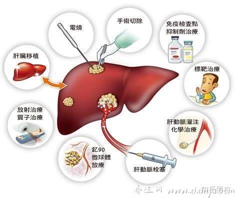  肝癌的晚期症状及表现有哪些