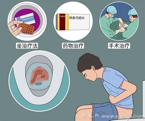  混合痔疮的最佳治疗方法