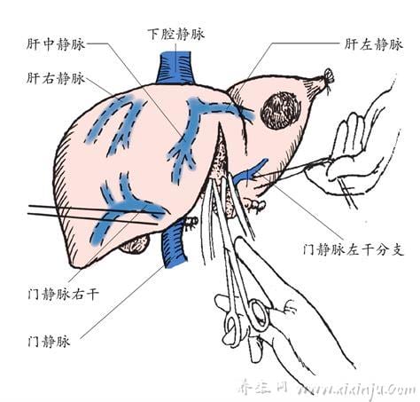  肝切除一半能活多久