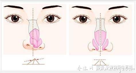  鼻畸形该如何矫正