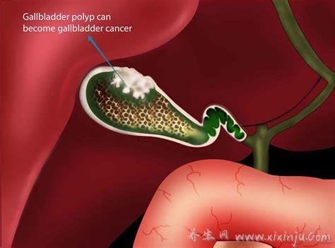  胆囊息肉症状